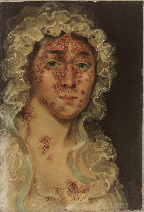 Mrs Bennett, Afflicted with a Skin Disease, 1819, 