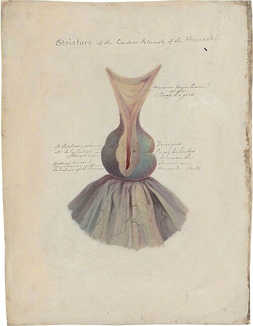 A Tumour Constricting the Entrance to the Stomach, , Jonathan Hutchinson